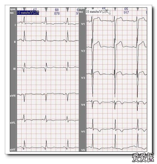 如rv3>1/2rv4;③同一导联的r波振幅在不同次的心电图记录中呈进行性