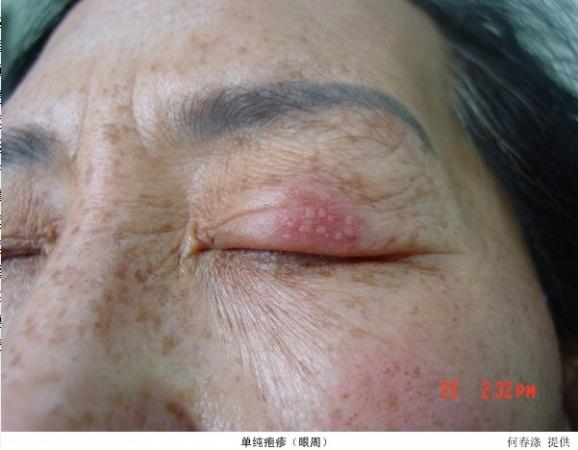 带状疱疹诊治大全