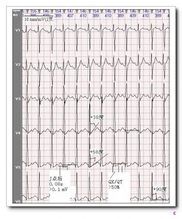 山羊老师课程常见心电图基础知识讲座第十讲—st段分析