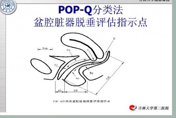 分享pop-q分类法