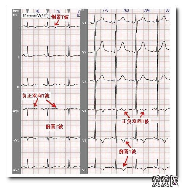 0 mv,符合冠状t波诊断标准.