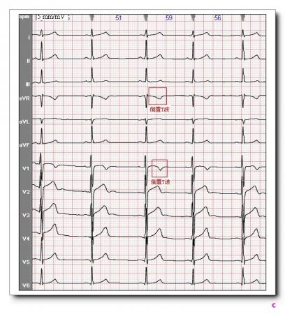 0 mv,符合冠状t波诊断标准.