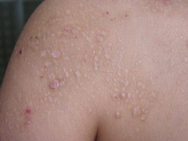 部分皮损表面出现白色栗粒样丘疹,可挤出小的白色颗粒,病情迁延不愈
