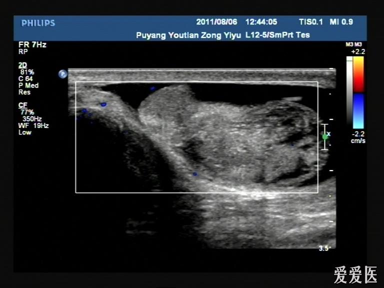 睾丸扭转 - 超声医学讨论版 - 爱爱医医学论坛 - 爱爱
