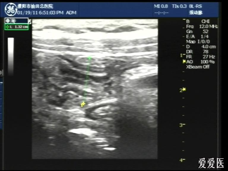 肠套叠 - 超声医学讨论版 - 爱爱医医学论坛-爱爱医医学网