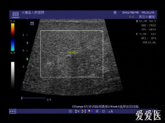 楼主dbxrmyy2011-08-09 18:53:26手术证实为右季肋部皮下脂肪瘤