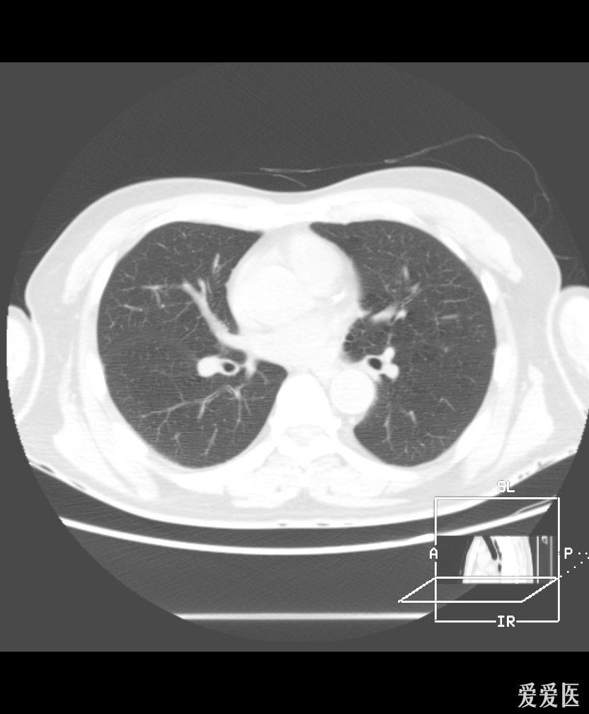 肺ct平扫,谈谈你的想法