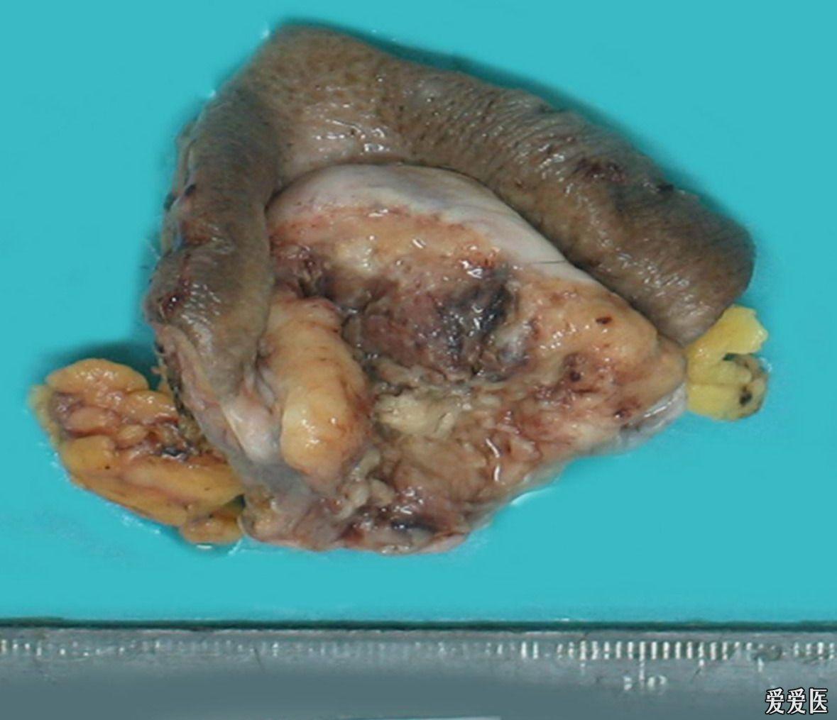 【病理每周一题】no.287(2011.8.15—8.21,答案已公布