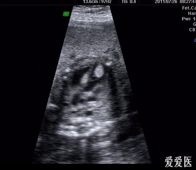 胎儿心脏横纹肌瘤 - 超声医学讨论版 - 爱爱医医学论坛 - 爱爱医医学