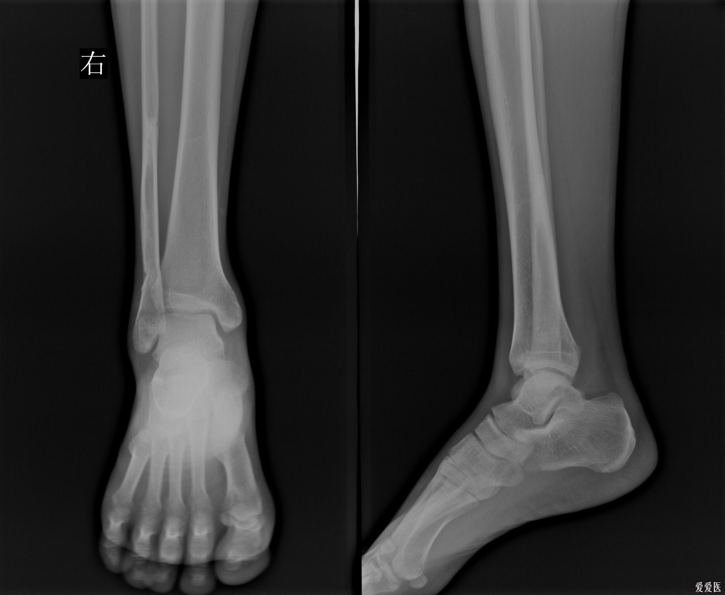 左腿胫腓骨骨折 虾米图客