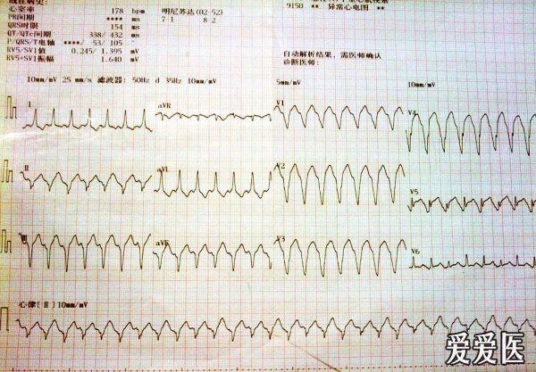 请教一份疑难心电图求正解!