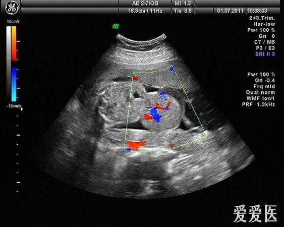 胎儿脐膨出:引产后证实,可惜没有引产后照片