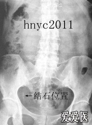 楼主hnyc20112011-08-20 10:08:41患者,女性,40岁,因右输尿管结石,6年