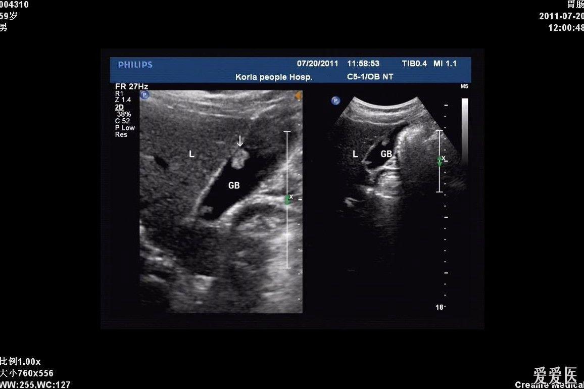 胆囊息肉 超声医学讨论版 爱爱医医学论坛 爱爱医医学网