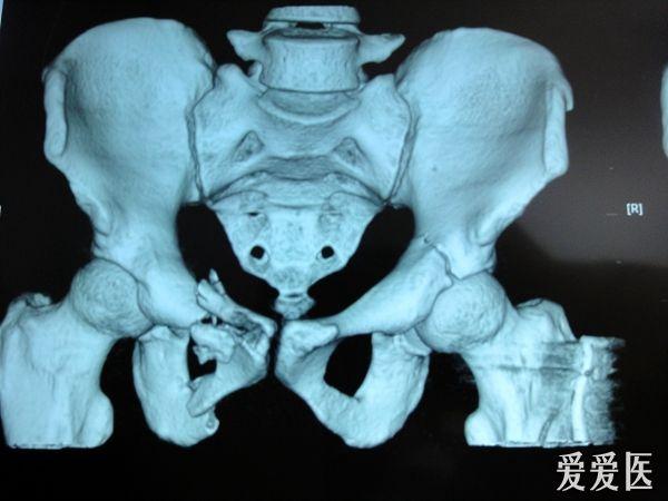 开放性骨盆骨折合并巨大创面