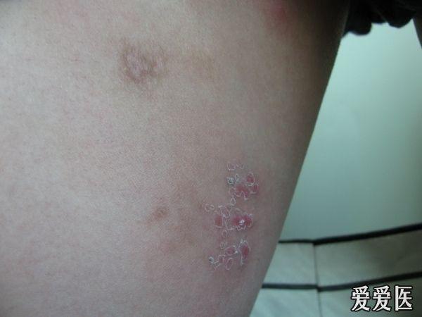 大腿内侧皮疹------复发性单纯疱疹