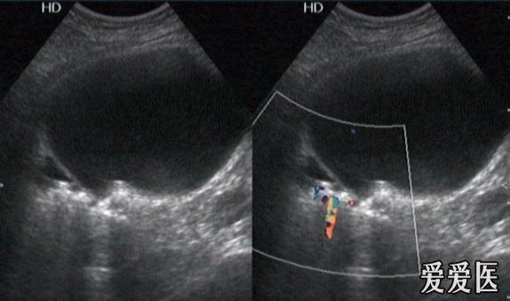 好大的膀胱结石 - 超声医学讨论版 - 爱爱医医学论坛 - 爱爱医医学网