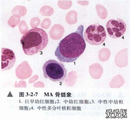 公孙少秋        二,巨幼细胞性贫血  (ma)    巨幼红细胞性贫血简称