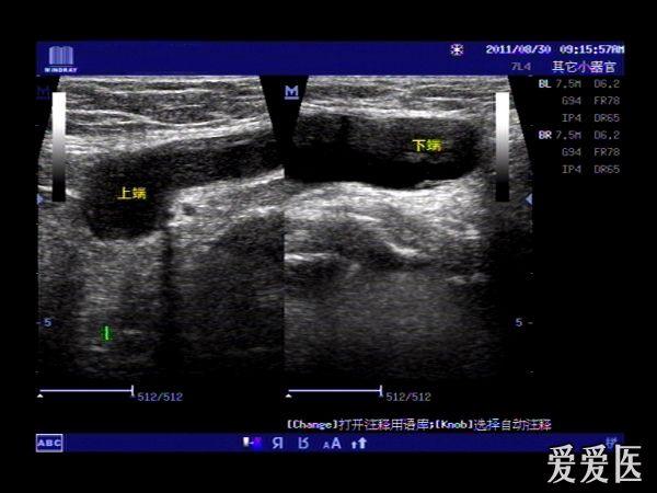 右侧腹股沟囊性包块---------圆韧带囊肿?