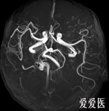 典型脑血管畸形-mri,mra,dsa