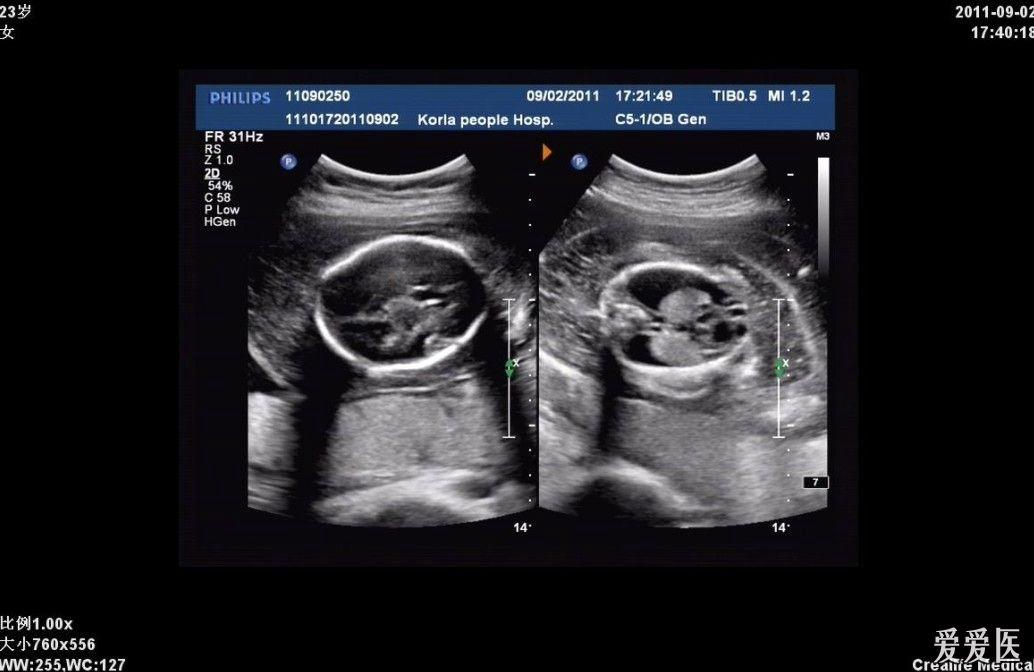 1胎宫内死亡_胎宫宝测女儿准吗_1胎宫内死亡