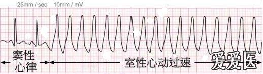 呼吸版经验交流(2)呼吸科医生学心电图—看图识字 ecg