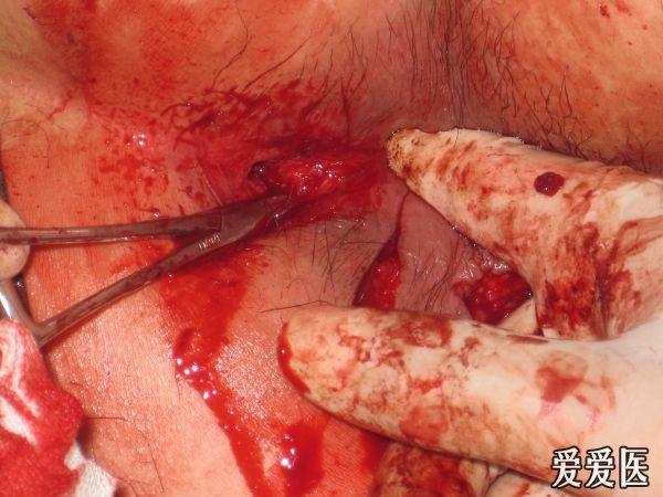 4月前因"肛门部持续性胀痛10天"在本科骶麻下行肛周脓肿一期根治术