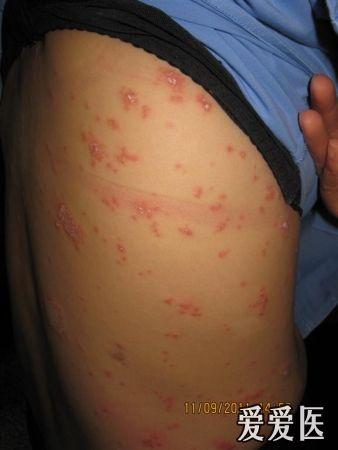 是玫瑰糠疹,带状疱疹,急性痘疮苔藓样糠疹,疱疹样皮炎?还是