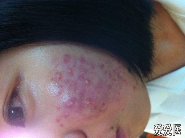 面部痤疮合并马拉色菌感染皮损