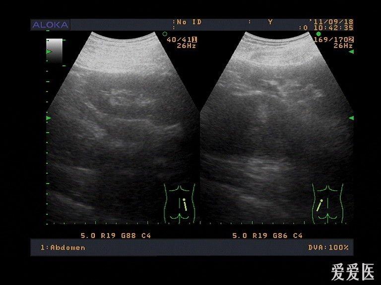 腹腔区左肾下极混合性回声