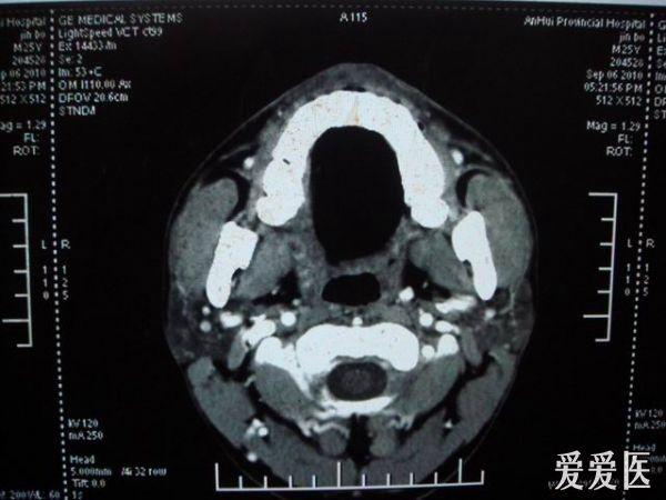 大家帮我诊断 咽旁间隙异物 单侧鼻咽部颈部强烈异物感扎痛!