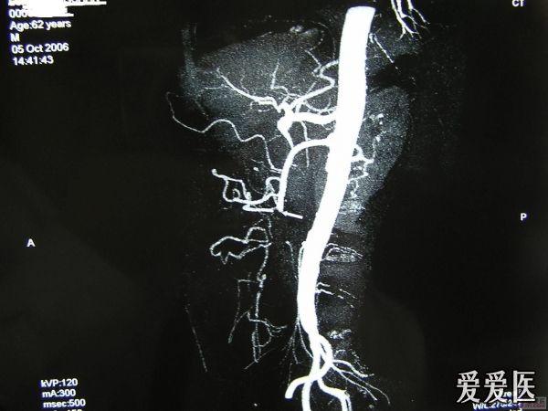 急腹症-----肠系膜上动脉栓塞(smae)误诊分析,请进!