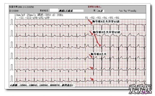 (015502-方-男-80岁-异常q波五年) 图5-36  陈旧性前壁心肌梗死伴左