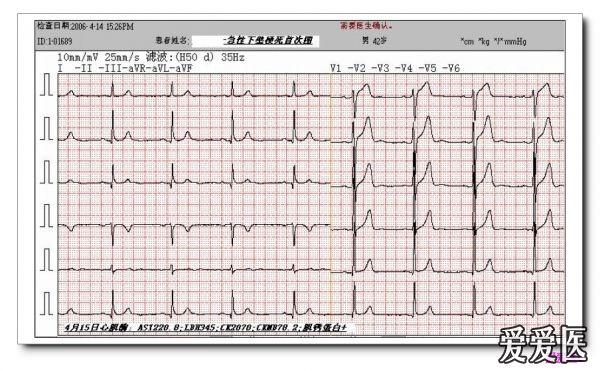 山羊老师课程常见心电图诊断知识讲座第二十五讲 急性心肌梗死