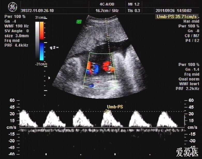 脐血流 - 超声医学讨论版 - 爱爱医医学论坛-爱爱医