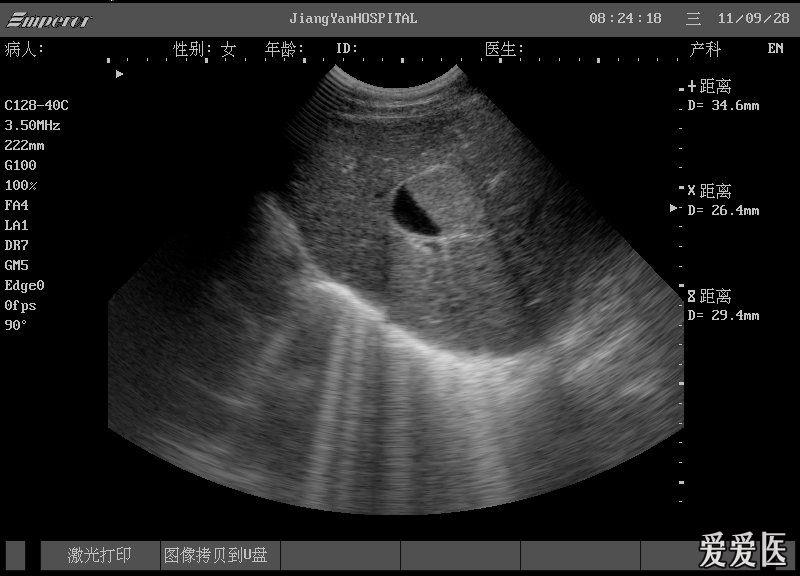 看看这个肝内包块 超声医学讨论版 爱爱医医学论坛 爱爱医医学