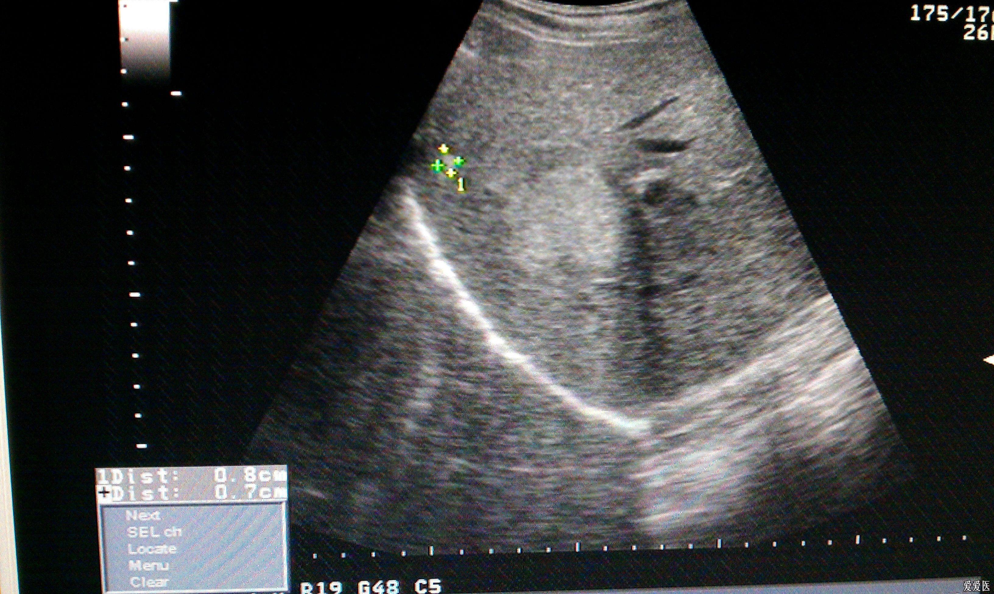 肝内多发血管瘤? - 超声医学讨论版 - 爱爱医医学论坛