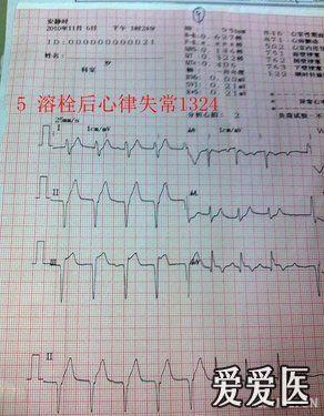 分享一例急性心梗溶栓再通典型病例,心电图奉上!