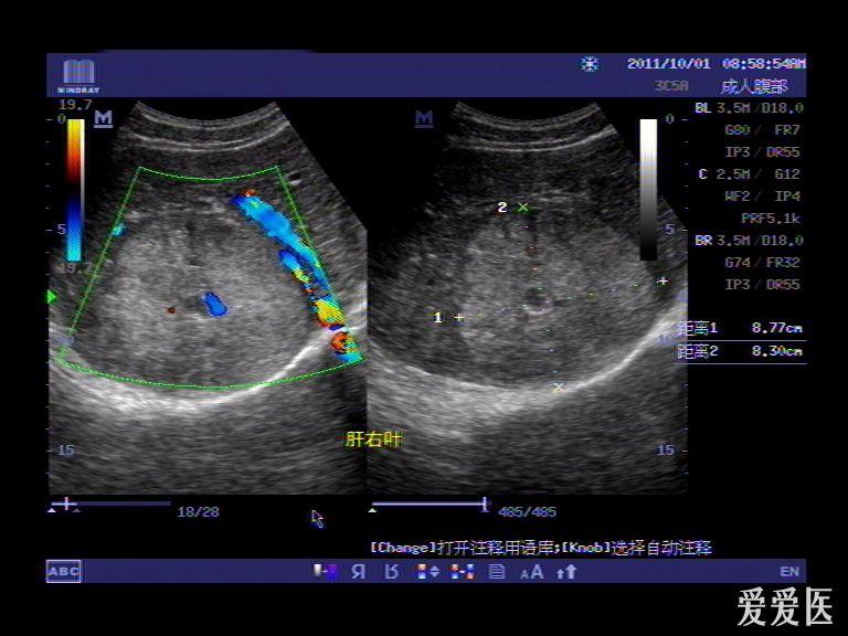 典型的病例(肝癌 门静脉癌栓形成) 沉重的心情 - 超声医学讨论版