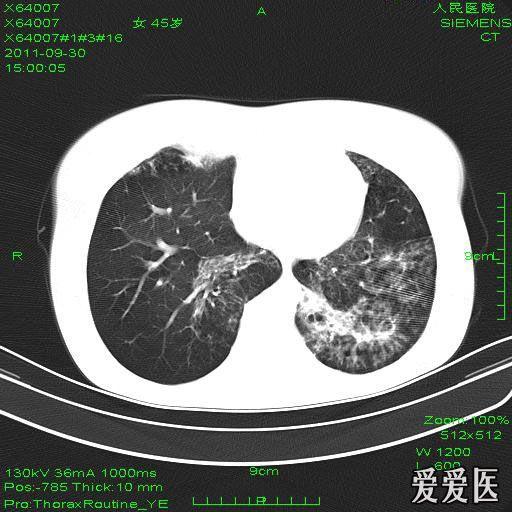 支气管扩张并咯血?