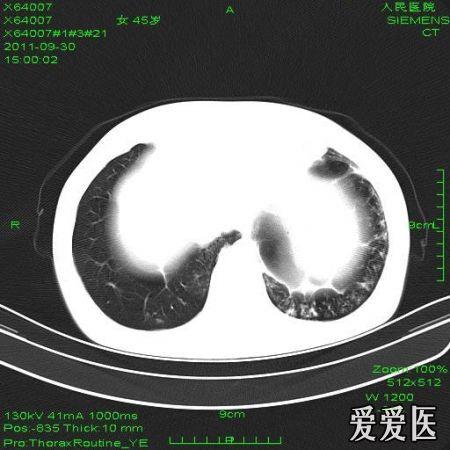 支气管扩张并咯血?