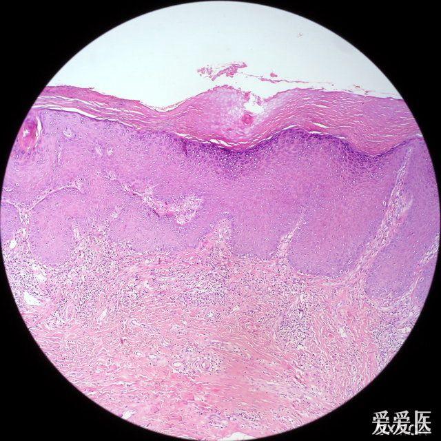 肉眼似皮炎,镜下似尖锐湿疣和疣状癌