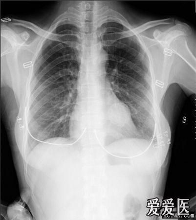 行常规胸透检查发现左房区一圆形肿块随心影搏动,故照胸片 沙发回复