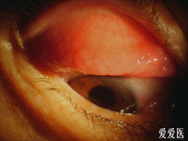 给病人下的诊断,诊断标准需要眼睑滤泡,角膜血管翳(或角膜沙眼小凹)