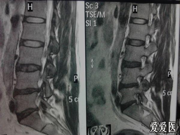 腰椎间盘突出症是否内固定,腰5-骶1是否手术?