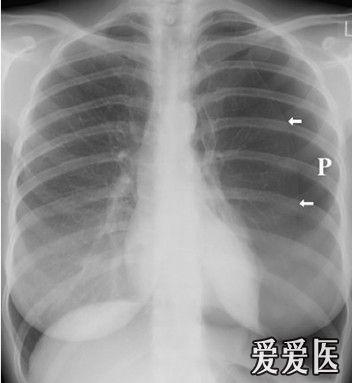呼吸版经验交流(7)气胸:影像学解读指南