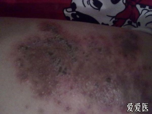 孕妇皮肤湿疹恶化了,救命啊
