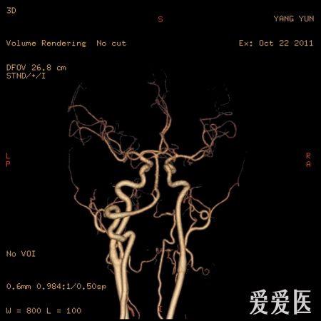 43岁,女性,反复头晕不适,b超颈部血管提示供血不足,进一步颈部血管cta