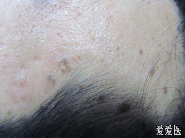 脂溢性角化病