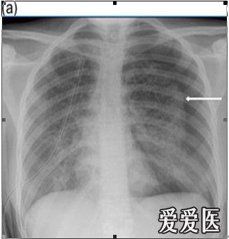 呼吸版经验交流(7)气胸:影像学解读指南